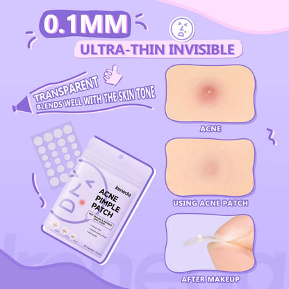 IRENEDA - Acne Pimple Patch